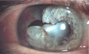 Trauma cataract